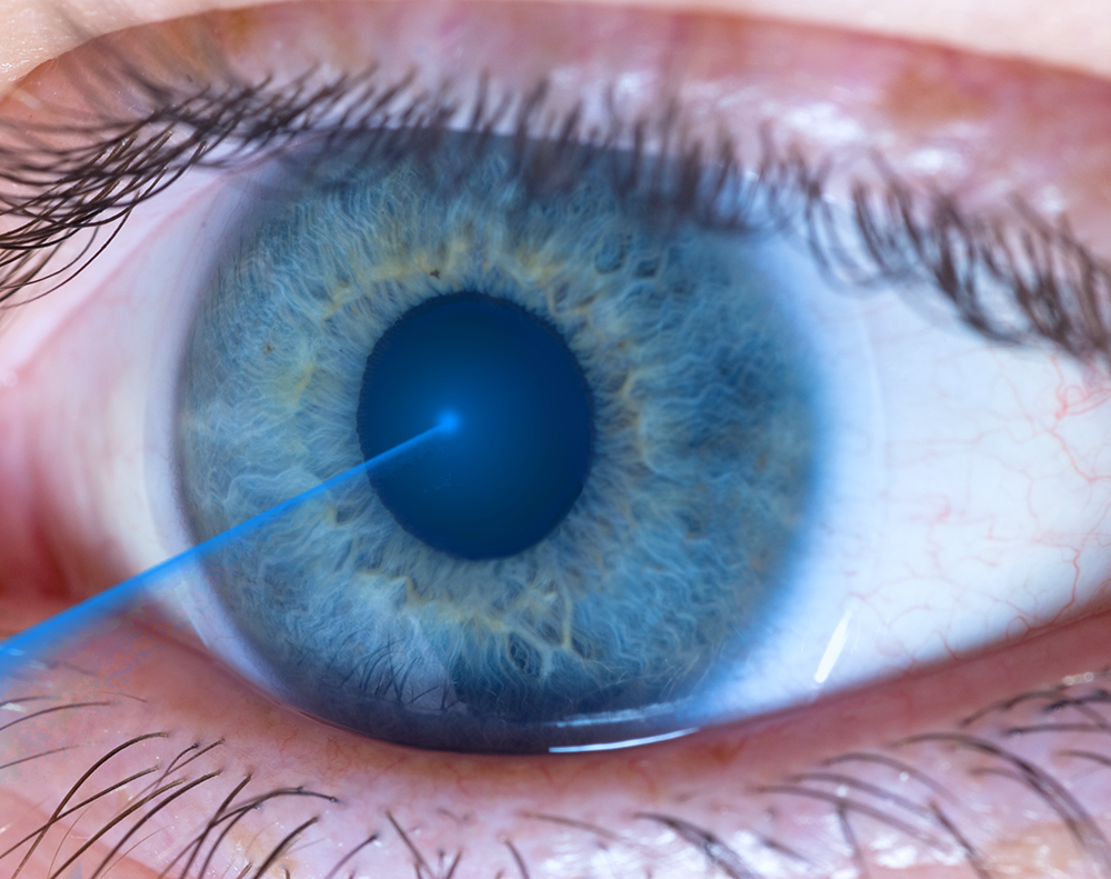 LASIK com laser femtosegundo é melhor do que com lâmina?